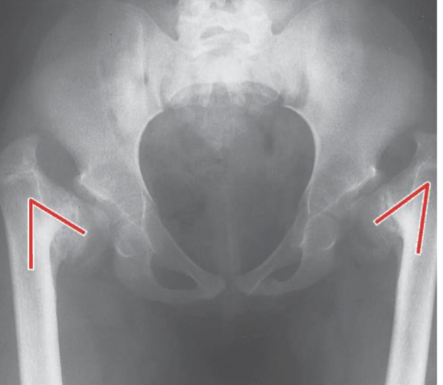 <p><strong>Coxa Vara</strong> (Femoral Head Coverage (Area),  MA of Glut Med, Force Needed from Glut Med, Joint Stress, Bending Moments)</p>