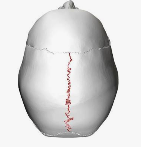 <p>Which suture is this?</p>