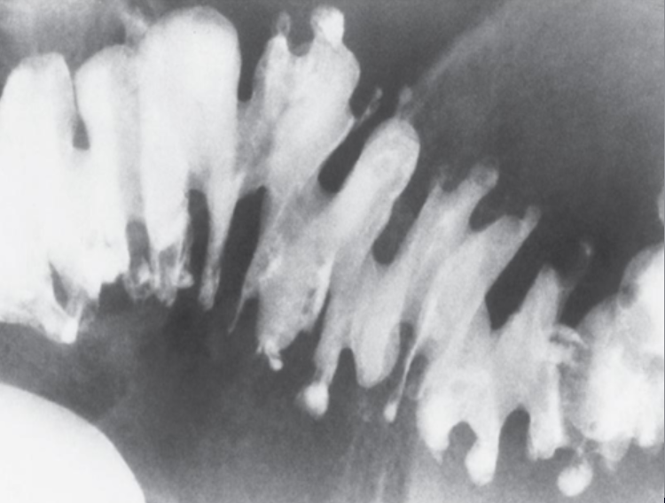 <p>Condition of having numerous diverticula or small, outpouchings of colon.</p>