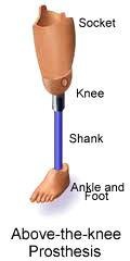 <p>Amputation above the knee joint.</p>