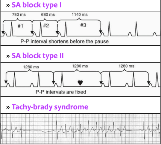 <p>Abnormality in SA node action potential generation or conduction, causing inappropriate sinus bradycardia, alternating bradycardia and tachycardia, sinus pause, SA nodal block, or chronotropic incompetence </p><p>-Sx: exercise intolerance, fatigue, dizziness, HA, nausea, palpitations, CP, SOB, syncope </p><p>-Tx: atropine, percutaneous pacing </p>