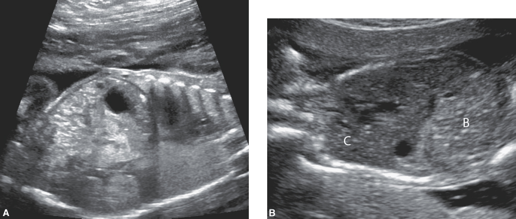 <p>trisomy 21, cystic fibrosis, growth restriction, fetal demise, congenital infections such as cytomegalovirus, and gastrointestinal obstructions.</p>