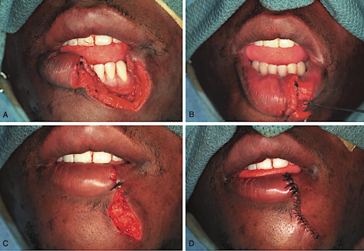 <ul><li><p><strong>gingiva, alveolar mucosa, floor of the mouth</strong></p><ul><li><p>closed in <span style="color: red;">1 layer</span></p></li><li><p><span style="color: red;">mucosal</span> layer</p></li></ul></li><li><p><strong>tongue or lip involving muscle</strong></p><ul><li><p>closed in <span style="color: red;">2 layers</span></p></li><li><p><span style="color: red;">muscle & mucosal</span> layer</p></li></ul></li><li><p><strong>entire thickness of the lip</strong></p><ul><li><p>closed in<span style="color: red;"> 3 layers</span></p></li><li><p><span style="color: red;">oral, muscle, dermal </span>layer</p></li></ul></li></ul><ul><li><p>key principle:</p><ul><li><p>all tissue layers should be properly positioned</p></li><li><p>number of layers depends on the location and depth of the laceration</p></li></ul></li></ul><p></p>