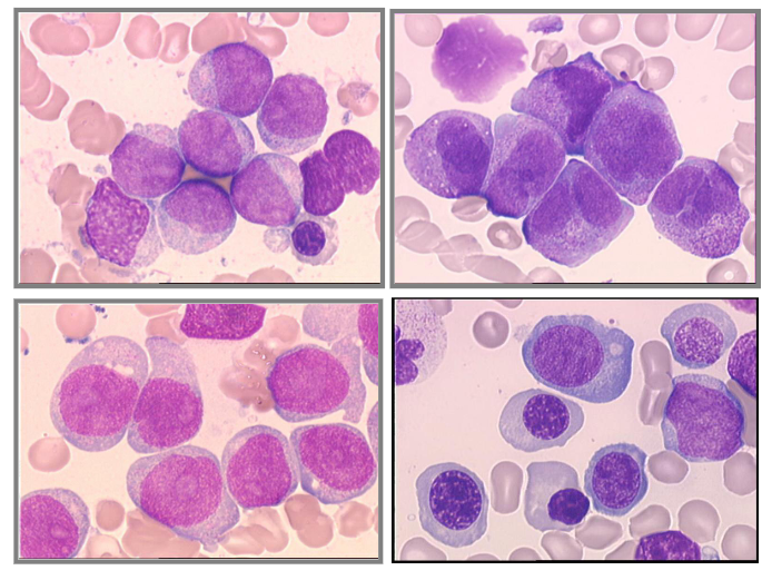 <p>- different morphological subtypes of acute myeloid leukaemia</p>
