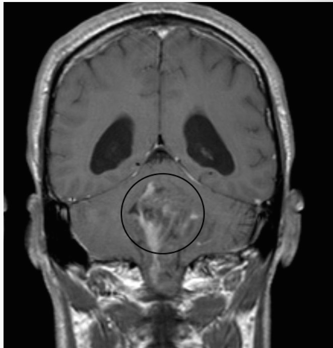 <p>Tumor of the ependymal cells that line the ventricles, in fourth ventricle in kids, vomiting, vision loss, </p>