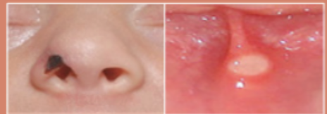 <p>found on the mucosal membrane, typically caused by a device at injury location</p><ul><li><p>can’t be staged due to the anatomy of mucous membrane</p><ul><li><p>can be caused by supplemental oxygen, CPAP, nasal prongs, endotracheal tube</p></li></ul></li></ul><p></p>