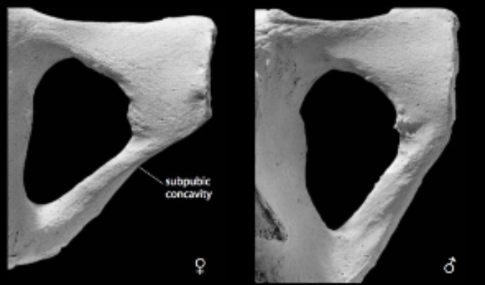 <p>Subpubic Concavity - Pelvis </p>