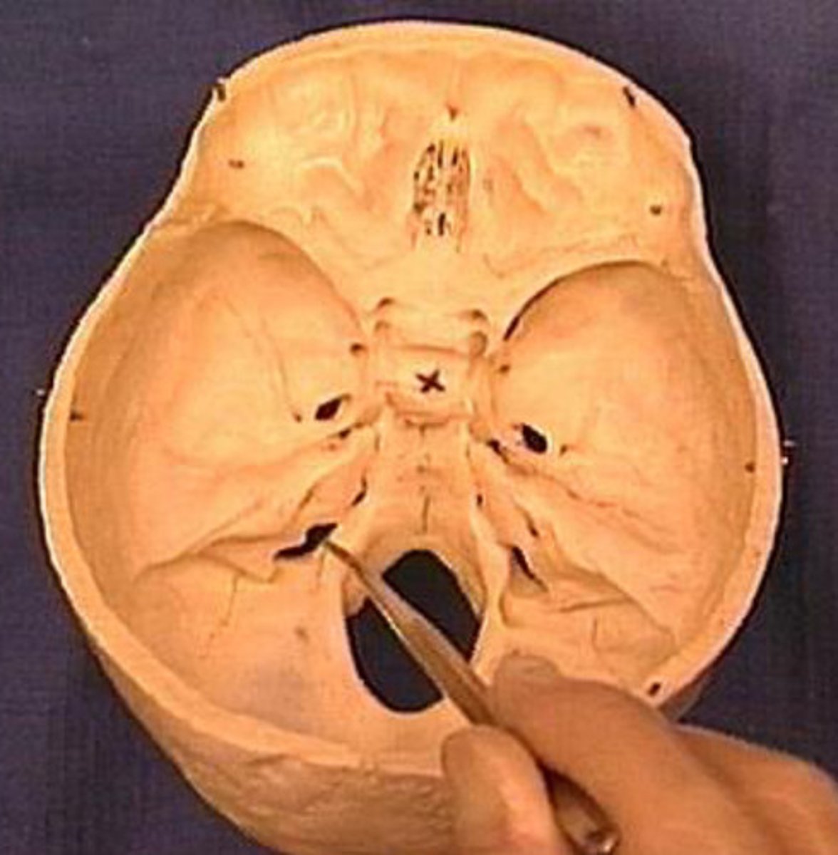 <p>Skull Opening:</p><p>Jugular foramen</p><p>Muscle Group:</p><p>Pharyngeal</p><p>Key Muscles:</p><p>Stylopharyngeus </p><p>Main Function:</p><p>Swallowing, gag reflex</p><p>Clinical Correlation:</p><p>Brainstem lesion</p><p>Classic Symptoms:</p><p>Loss of gag reflex</p>