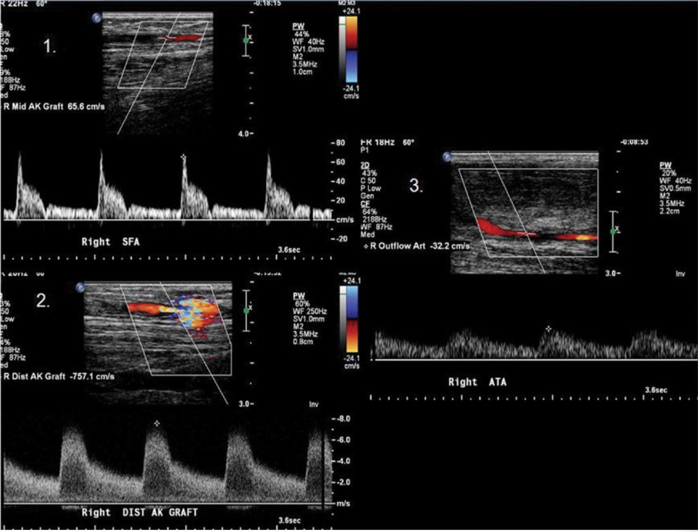 <p>The images in Figure 4–52 were obtained from a patient in order 1, 2, and 3 from proximal to distal in a lower extremity bypass graft. What do these findings suggest?</p><p>(A) Normal</p><p class="p1">(B) 1% to 19% stenosis</p><p class="p1">(C) 20% to 49% stenosis</p><p class="p1">(D) 50% to 99% stenosis</p>