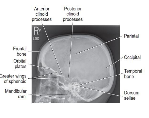 <p>lateral</p>