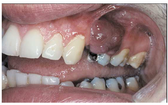 <p>1.what is this lesion?</p><p>2. how to treat/ manage it?</p><p>3. classification of oral lesion in HIV?</p>
