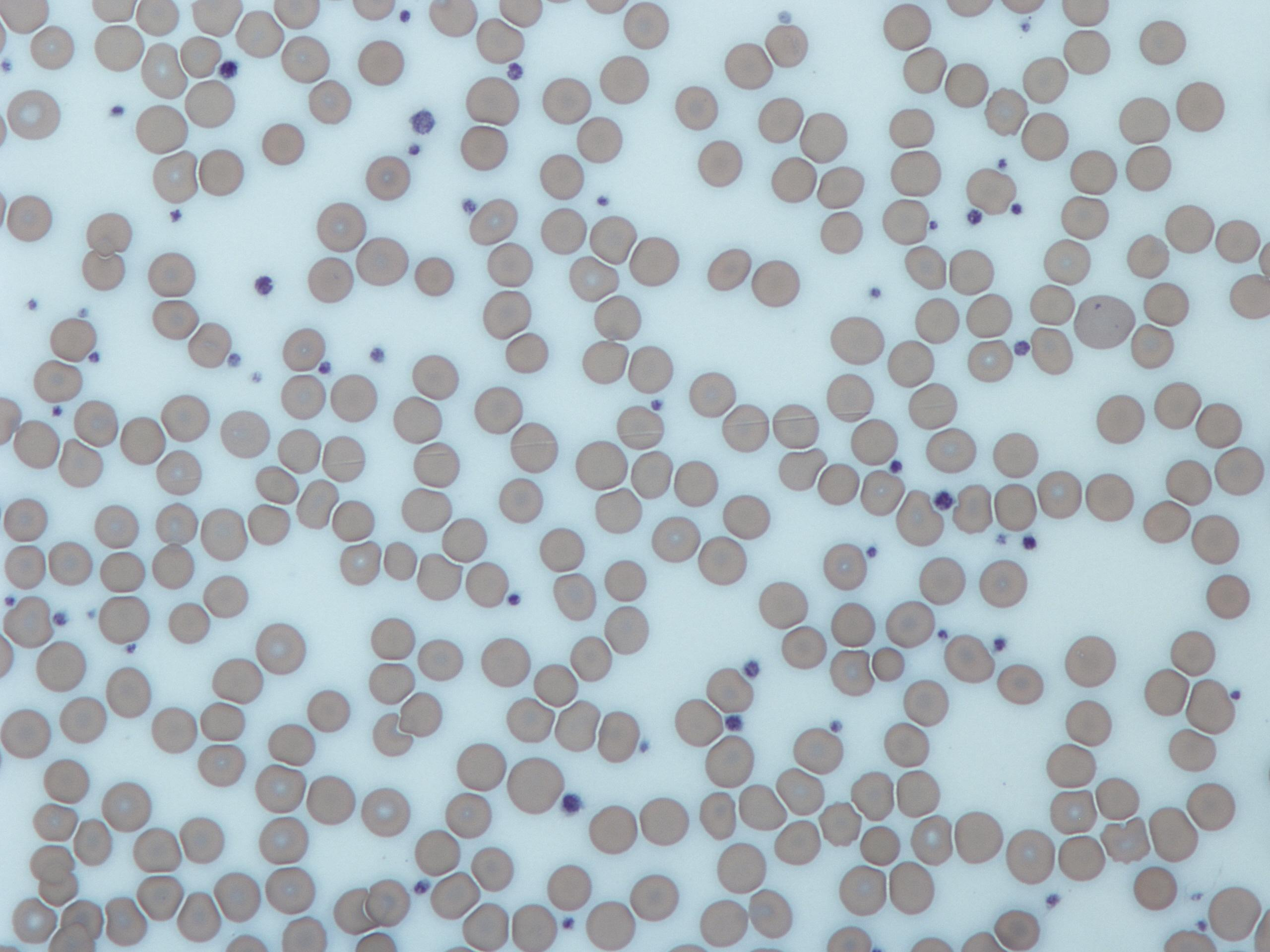 <p><span style="background-color: transparent;">Cell fragments called thrombocytes. Hemocytoblasts (stem cells) differentiate into megakaryocytes that fragment into platelets. They are ~½ the size of red blood cells. There are 130,000-360,000 _______ per cubic millimeter of blood. They help stop bleeding by sticking together to form plugs and secrete the hormone serotonin, which acts to vasoconstrict the vessels.</span></p>