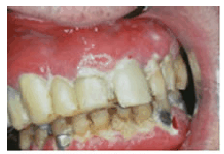 <p>Autoimmune disease that attacks the <span style="color: rgb(13, 254, 21);">SALIVARY GLANDS</span> leading to <span style="color: rgb(235, 55, 9);">XEROSTOMIA</span></p><p></p><p>Patients who cannot produce saliva (or produce very little) suffer from dental caries (cavities), dry mouth and infection & inflammation of the buccal mucosa</p><p></p>