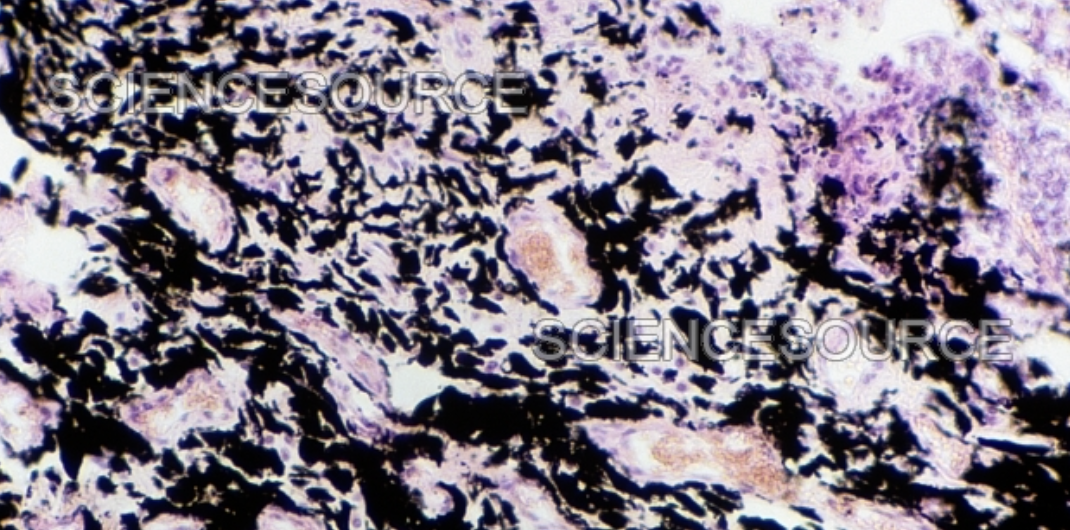 <p>Coal dust/black lung </p>