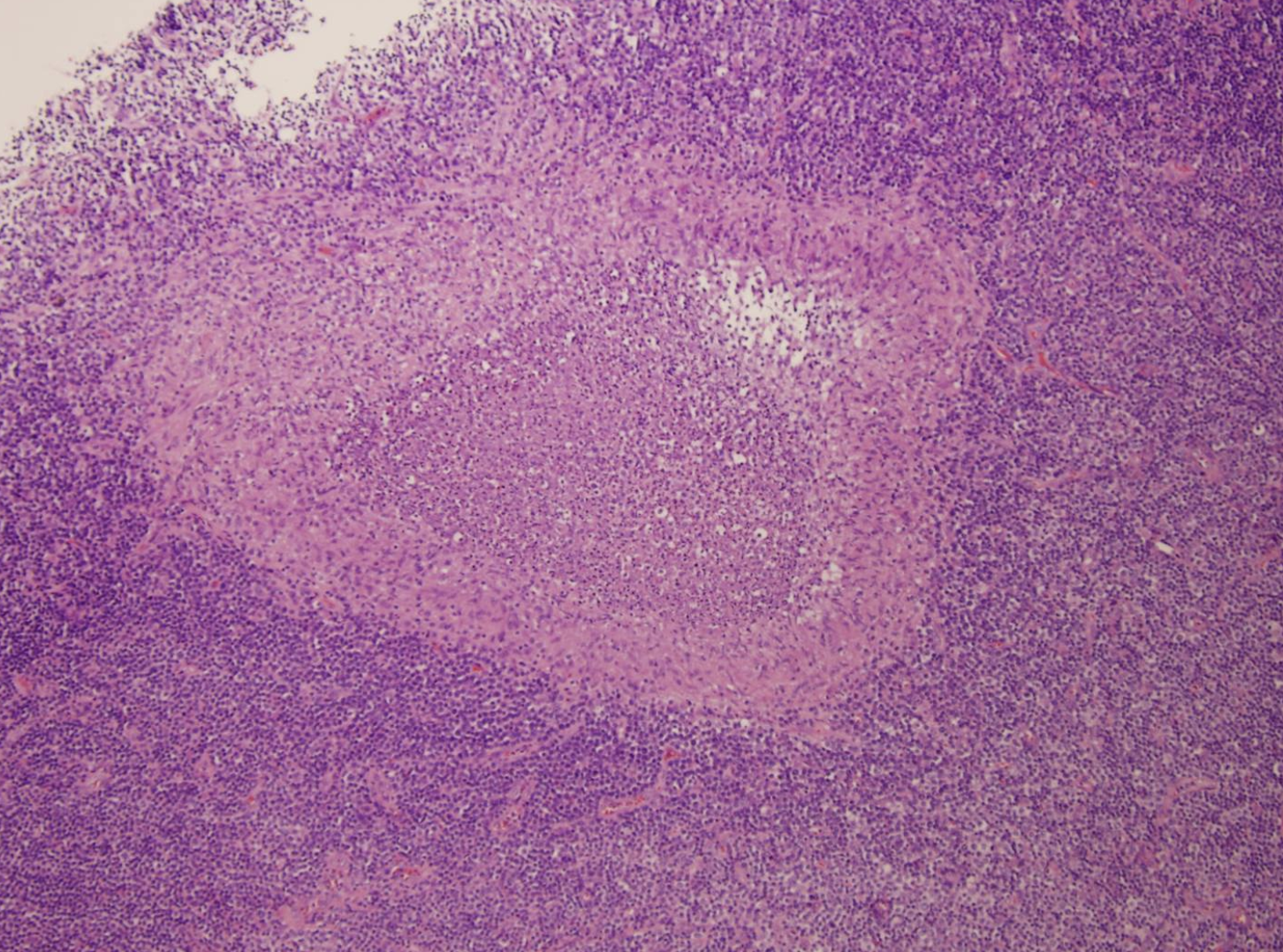 <p>Ulcère au niveau de l’iléon</p><p>1) diagnostic + étiologie</p><p>2) localisation</p><p>3) histologie</p>
