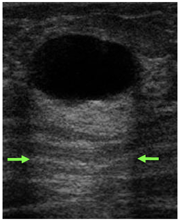 <p>enhancement artefact:</p><ul><li><p>Enhancement beyond a fluid-filled (low attenuation) region</p><ul><li><p>US passes through a region of low attenuation and is absorbed less than other US waves</p></li><li><p>The time gain compensation in the area after it then enhances it above surrounding levels (it was not needed as it was less attenuated)</p></li></ul></li><li><p>Time-gain-compensation is wrong as attenuation is not uniform</p></li></ul><p></p><p>the reverse can occur producing shadow artefacts:</p><ul><li><p>strong absorber prevents US beam from reaching area behind it</p></li><li><p>time gain compensation is insufficient leaving a dark shadowy area</p></li></ul><p></p><p>refraction artefacts:</p><ul><li><p>different medium densities causes sound speed to change → beam bends</p></li><li><p>causes objects to appear in the wrong place or missed </p></li></ul><p></p>