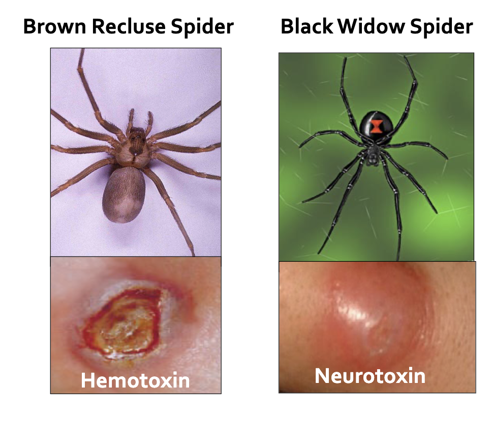 <ul><li><p>Black Widow</p><ul><li><p>Neurotoxin</p></li><li><p>Jet black, glossy body</p></li><li><p>Large, round, globe-shaped abdomen</p></li><li><p>Signature marking: bright RED HOURGLASS on the BOTTOM of the abdomen</p></li><li><p>Long solid-black legs, no banding</p></li><li><p>8 eyes</p></li><li><p>Found in dark, dry spaces</p></li></ul></li><li><p>Brown Recluse</p><ul><li><p>Hemotoxin</p></li><li><p>Uniform tan/brown, matte body</p></li><li><p>Signature marking: dark brown VIOLIN shaped on the TOP of the cephalothorax (front section)</p></li><li><p>Oval, flat abdomen</p></li><li><p>Only 6 EYES in 3 pairs (most other spiders have 8)</p></li></ul></li></ul><p></p>