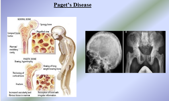 <ul><li><p>Low calcium diet</p></li><li><p>Lack of physical activity</p></li><li><p>Family History: if someone in your family has or had osteoporosis = more at risk</p></li><li><p>Gender: women are simply more likely to develop osteoporosis</p></li><li><p>Ethnicity: White and Asian people are more likely to be affected by osteoporosis</p></li></ul><p></p>