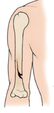 <p>seen in children</p><p>bone bends and partially breaks (break not through) </p>