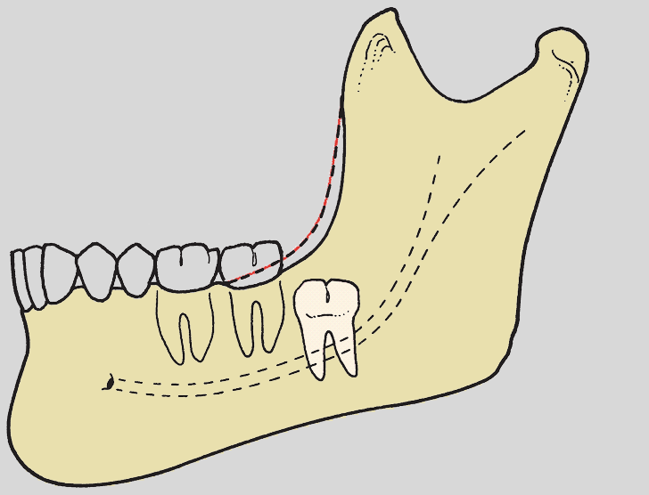 <p>what is the classification of overlying tissue?</p>