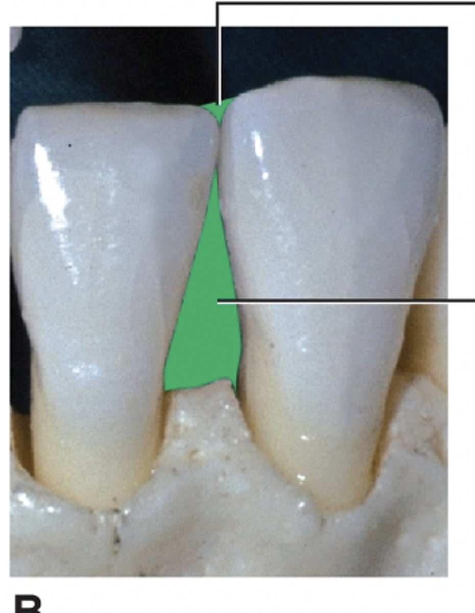 <p>triangular spaces surrounding a contact point of two teeth, as viewd from buccal/lingual and occlusal/incisal</p>