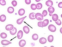 <p>myelofibrosis, thalassemia</p><p>other anemias extramedullary hematopoiesis, perncious anemia</p>