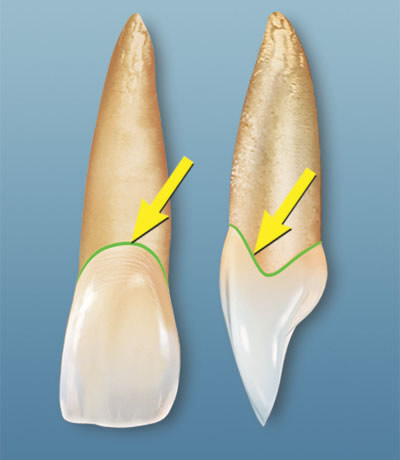 <p>incisal (occlusal)</p>