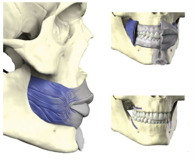 <ul><li><p>&nbsp;Superior part - alveolar process of maxilla</p></li></ul><ul><li><p class="p1">Inferior part - alveolar process of mandible</p></li><li><p class="p1">Posterior part - pterygomandibular raphe.</p></li></ul><p></p>