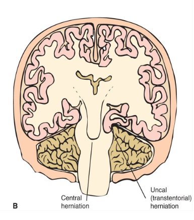 <p>Herniation associated with brainstem compression is called central herniation, whereas herniation associated with the supratentorial structures is called uncal (transtentorial) herniation. </p>
