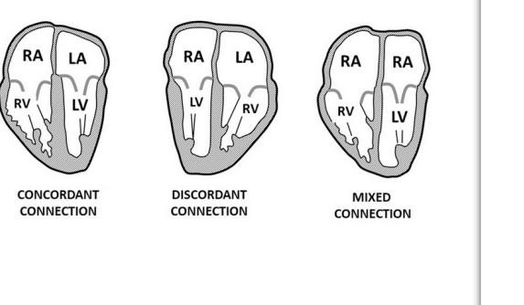 <p>The usual rightward looping of the heart tube (D—loop) leads to the morphological right ventricle being to the right of the morphological left ventricle</p>