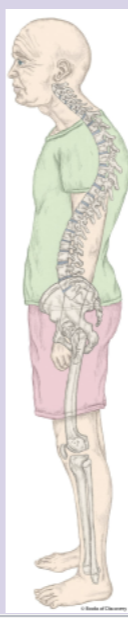 <p>this image best implicates which postural abnormality?</p><ul><li><p>dowagers hump</p></li><li><p>Sway back</p></li><li><p>Kordosis</p></li></ul><p></p>