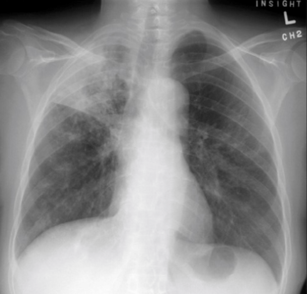 <p>Solid white area</p><p>Pneumonia/pleural effusion</p>