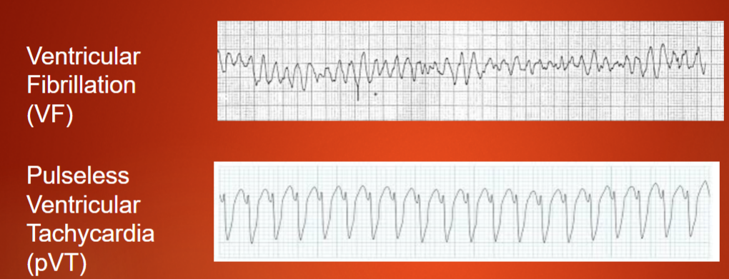 <ul><li><p>Ventricular Fibrillation (VF)</p></li><li><p>Pulseless Ventricular Tachycardia (pVT)</p></li></ul><p></p>