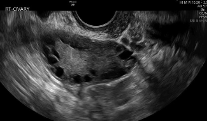 <ul><li><p>round ovaries w/ multiple cysts in the periphery → String of Pearls sign</p></li><li><p>ovary may appear normal</p></li></ul><p></p>