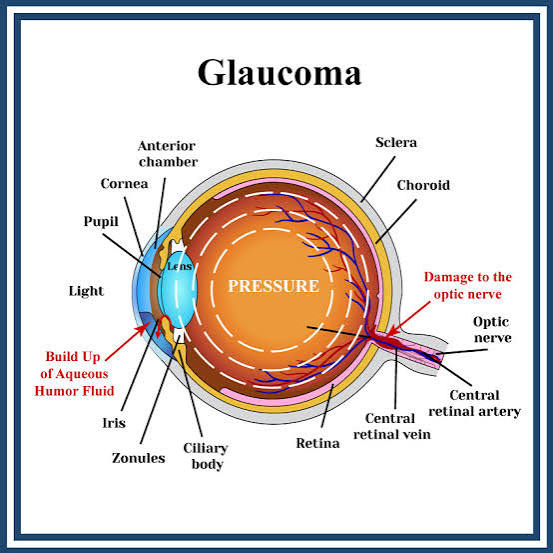 <p>Immediate administration of topical anti-glaucoma drops (timolol, apraclonidine, pilocarpine) plus systemic acetazolamide (or IV mannitol). </p>
