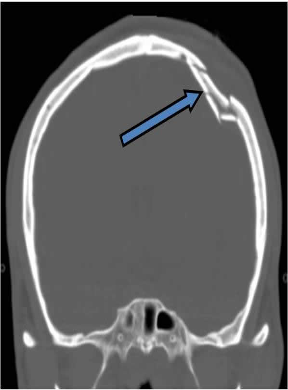 <p>A fracture especially of the skull in which the fragment is depressed below the normal surface</p>