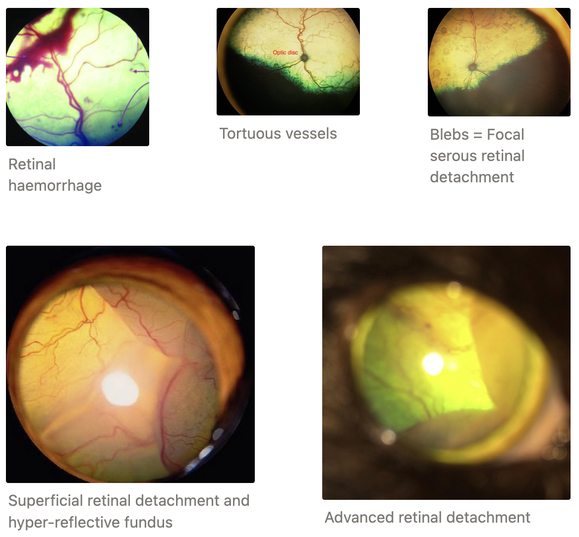 <p><strong>EYES #1</strong></p><ol><li><p>Sudden blindness (often reversible)</p></li><li><p>Retinal oedema</p></li><li><p>Dilated and tortuous retinal vessels</p></li><li><p>Hyphaema</p></li><li><p>Retinal detachment</p></li><li><p>Dilated, hyper-reflective fundus</p></li><li><p>Scleral/conjunctival hyperaemia/iris aneurism</p></li><li><p>Slow PLR</p></li><li><p>Secondary glaucoma </p></li></ol><p><strong>KIDNEYS</strong> = CKD and proteinuria</p><p><strong>BRAIN</strong> = High ICP</p><ol><li><p>Cerebrovascular accidents (stroke)</p></li><li><p>Depression</p></li><li><p>Seizure</p></li><li><p>Ataxia</p></li><li><p>Focal brain and spinal cord lesions (aneurism)</p></li></ol><p><strong>HEART AND BLOOD VESSELS</strong></p><ol><li><p>Gallop sounds</p></li><li><p>Murmurs</p></li><li><p>LV concentric hypertrophy (pressure overload due to high systemic BP)</p></li><li><p>LCHF</p></li><li><p>Arrhythmia</p></li><li><p>Bleeding due to blood vessel changes (epistaxis, stroke, aortic rupture)</p></li></ol><p></p><p><u>Vague Clinical Signs of Hypertension:</u></p><ol><li><p>Restlessness</p></li><li><p>Anxiety</p></li><li><p>Panting</p></li><li><p>Behaviour changes</p></li></ol><p></p>