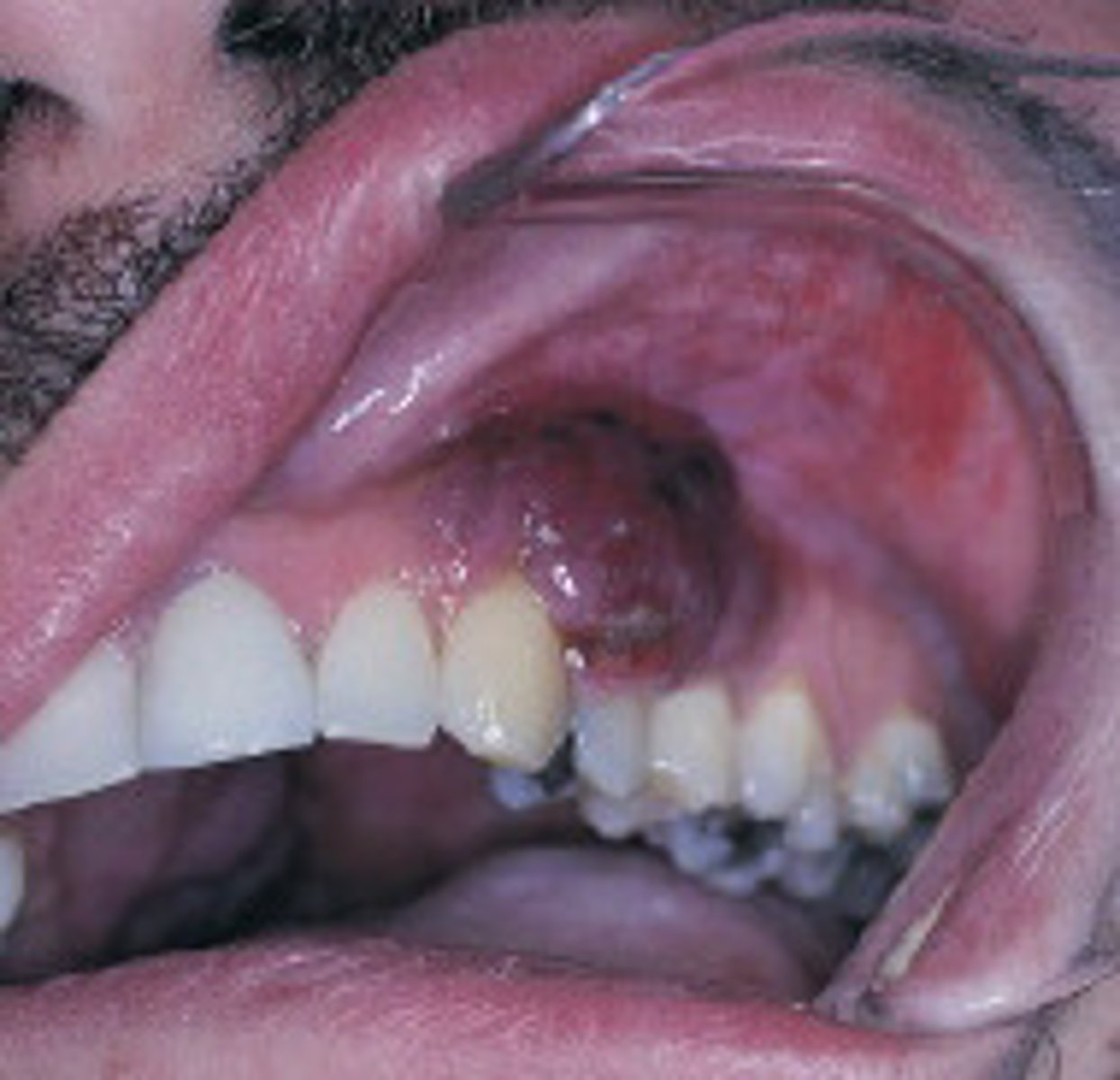 <p><br><span>The most common intraoral locations for this lesion are the gingiva and palate. When diagnosed, this vascular lesion meets the criteria for the diagnosis of acquired immune deficiency syndrome (AIDS). What is the name of this vascular lesion?</span></p>
