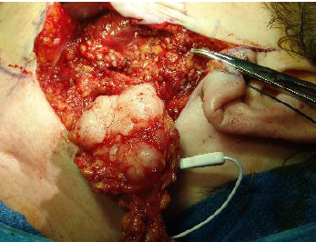 <p>pleomorphic ademona treatment and prognosis</p>
