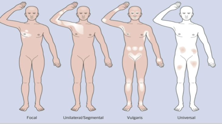 <p>Vitiligo definition</p>
