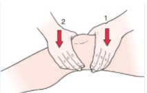 <p>Press suprapatellar pouch and anterior joint; fluid movement indicates significant knee joint effusion.</p>