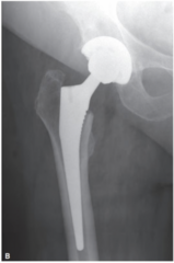 <p>Heavy metals absorb nearly all of the X-rays</p>