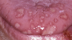 <p>Initial HSV infection (primary herpetic gingivostomatitis).</p>