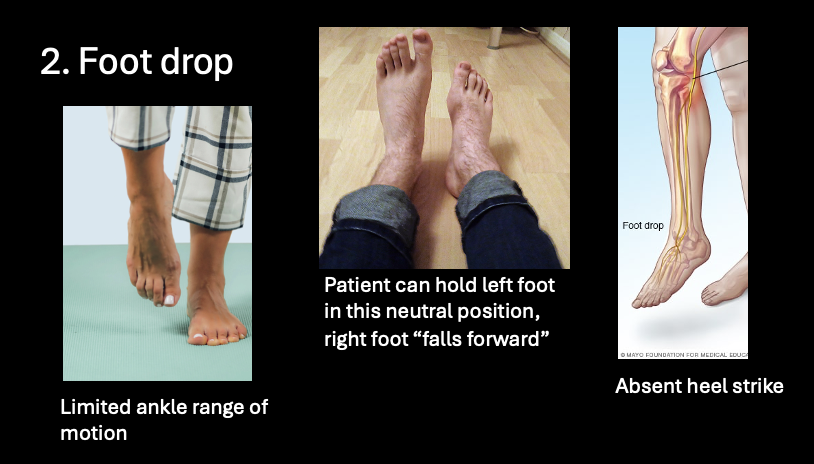 <p><u>Foot Drop</u></p><p>-action impeded</p><p>-muscles affected</p><p>-innervation</p><p>-roots of the nerve</p><p>-where paresthesia</p>