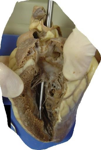 <p><span>The valve in this picture is the bicuspid valve.&nbsp; Therefore, what type of blood would be found in this side of the heart?</span></p>