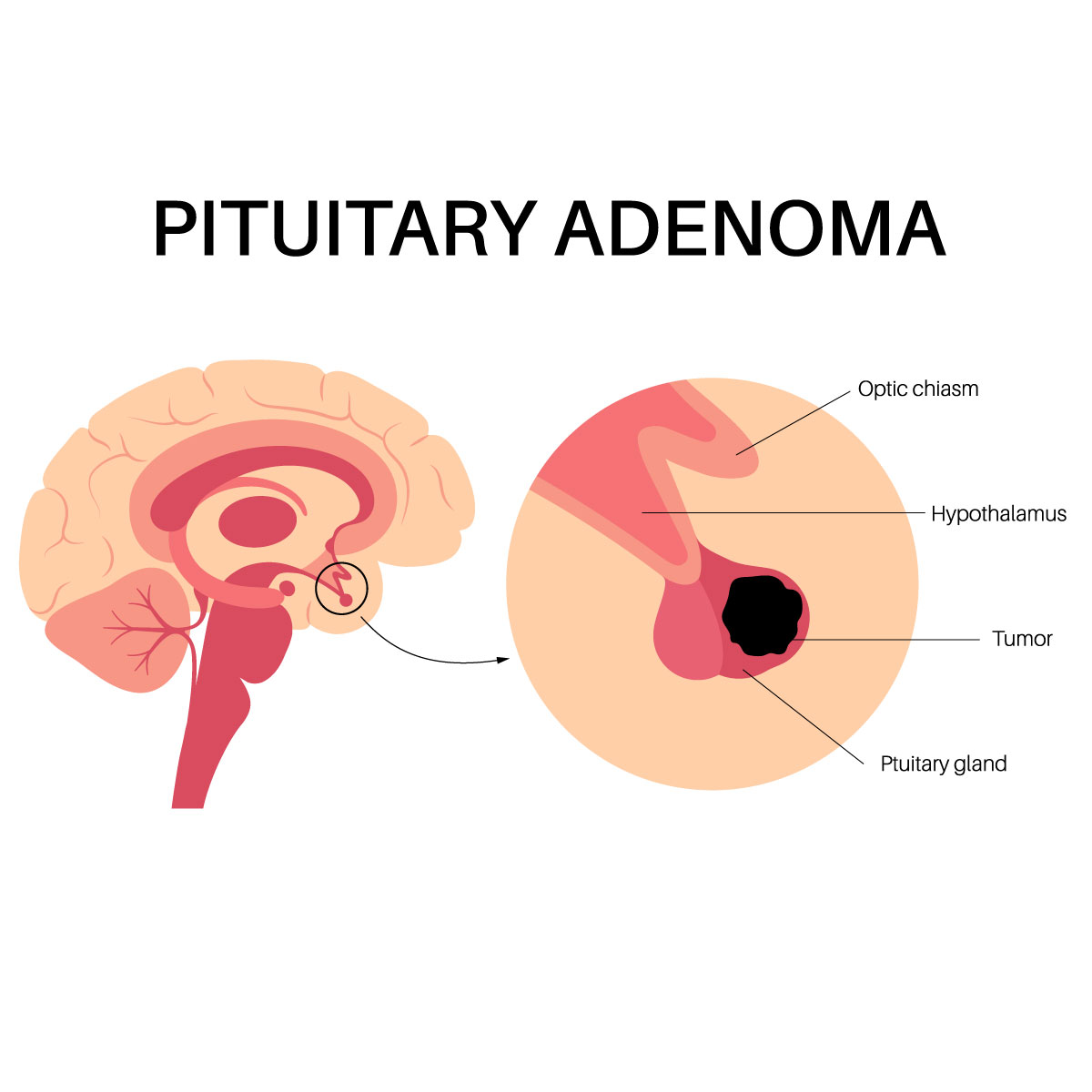 <p>pituitary adenoma (definition, S/E, comps, and tx)</p>