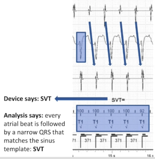 <p><strong>Evaluate detection</strong></p><p>Confirm rhythm detected</p><p>Evaluate sensing</p><p>Assess discriminator function</p><p></p>
