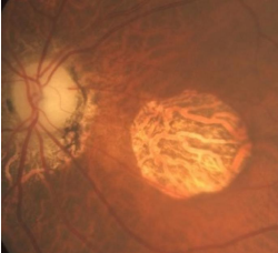 <ul><li><p>Late-stage AMD</p></li><li><p>Loss of photoreceptors and RPE</p></li><li><p>On the fovea → Permanent, central scotoma</p></li></ul><p></p>