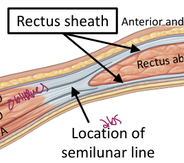 <p>Curved lateral border of the rectus abdominis where the abdominal aponeuroses converge (11 line)  </p>