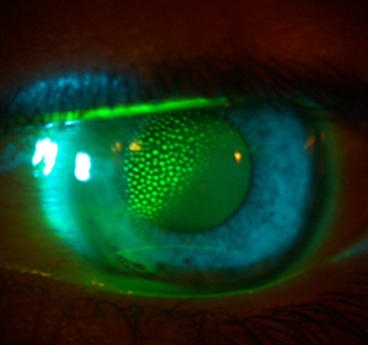 <p>not true staining, but rather pooling of the dye into corneal indention caused by trapped air bubbles under a poorly fitting rigid gas permeable contact lens. It presents as sharply demarcated, circular patterns of stain on the cornea.</p>